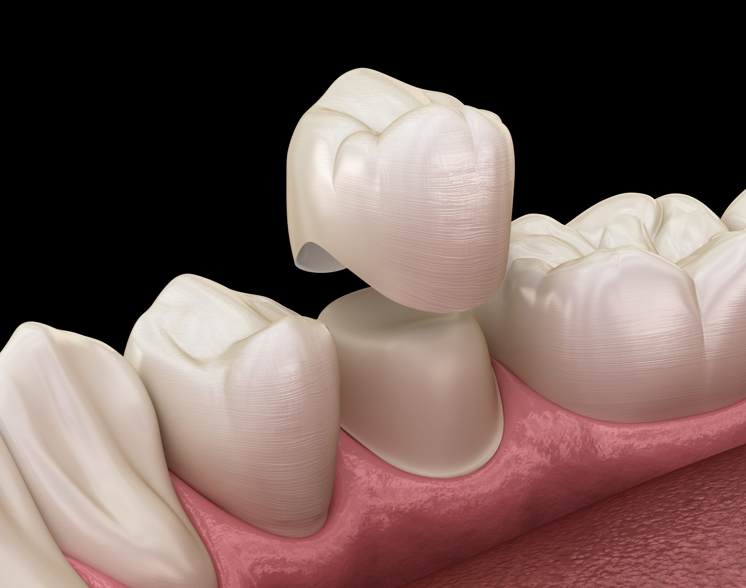 An image of a Dental Crown offered at Darren Gonzales DDS in Santa Rosa, CA