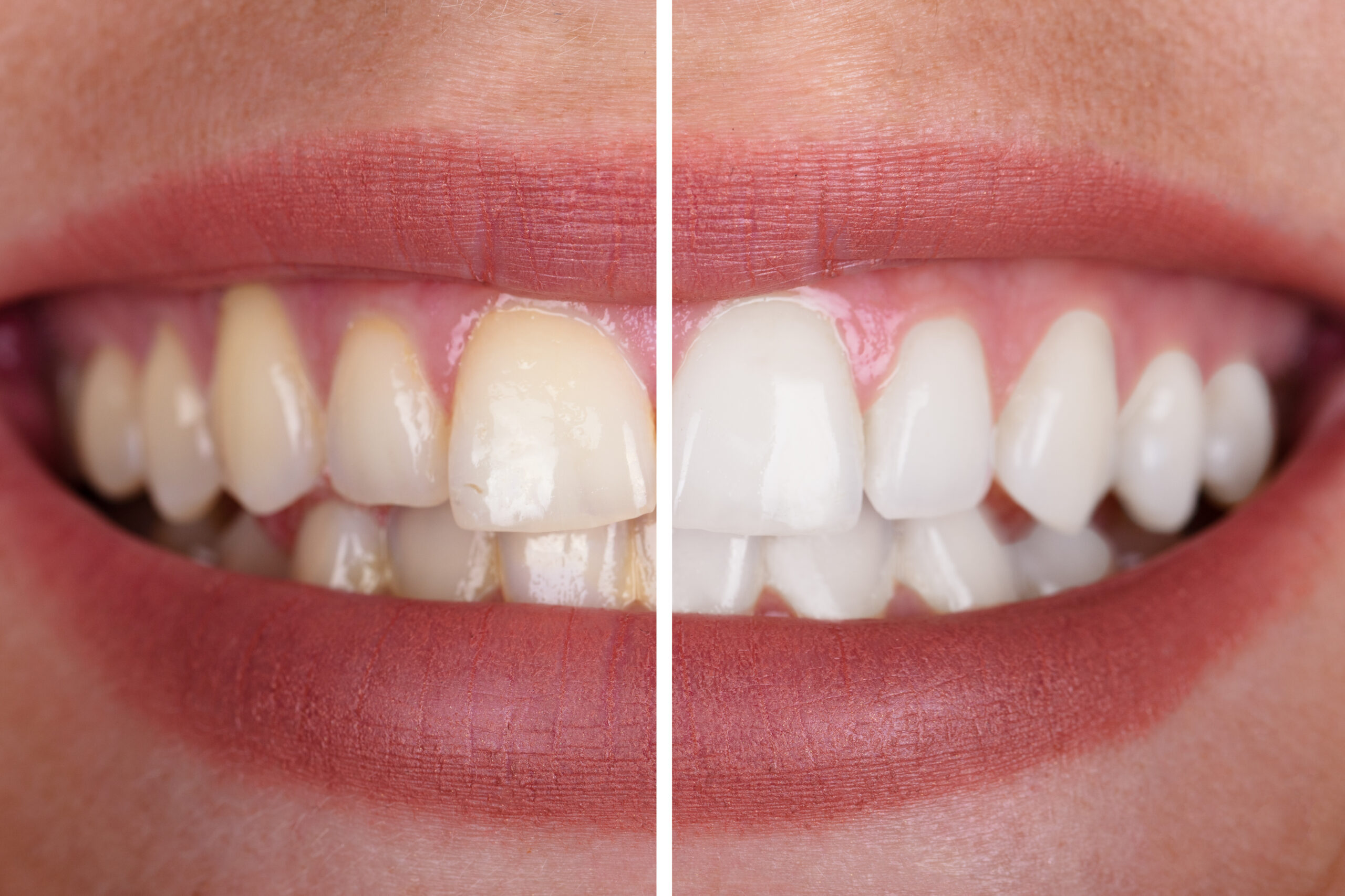 Teeth Whitening Results at Darren Gonzalez DDS in Santa Rosa, CA 95405