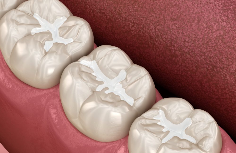 Molar Fissure dental fillings, Medically accurate 3D illustration of dental concept Close up image of cavity fillings done by Darren Gonzalez DDS in Santa Rosa, CA 95405