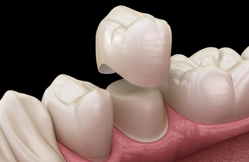 Dental crown premolar tooth assembly process. Medically accurate An image of a Dental Crown offered at Darren Gonzales DDS in Santa Rosa, CA