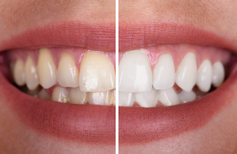 Woman’s Teeth Before And After Whitening Teeth Whitening Results at Darren Gonzalez DDS in Santa Rosa, CA 95405